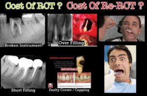 root canal cost