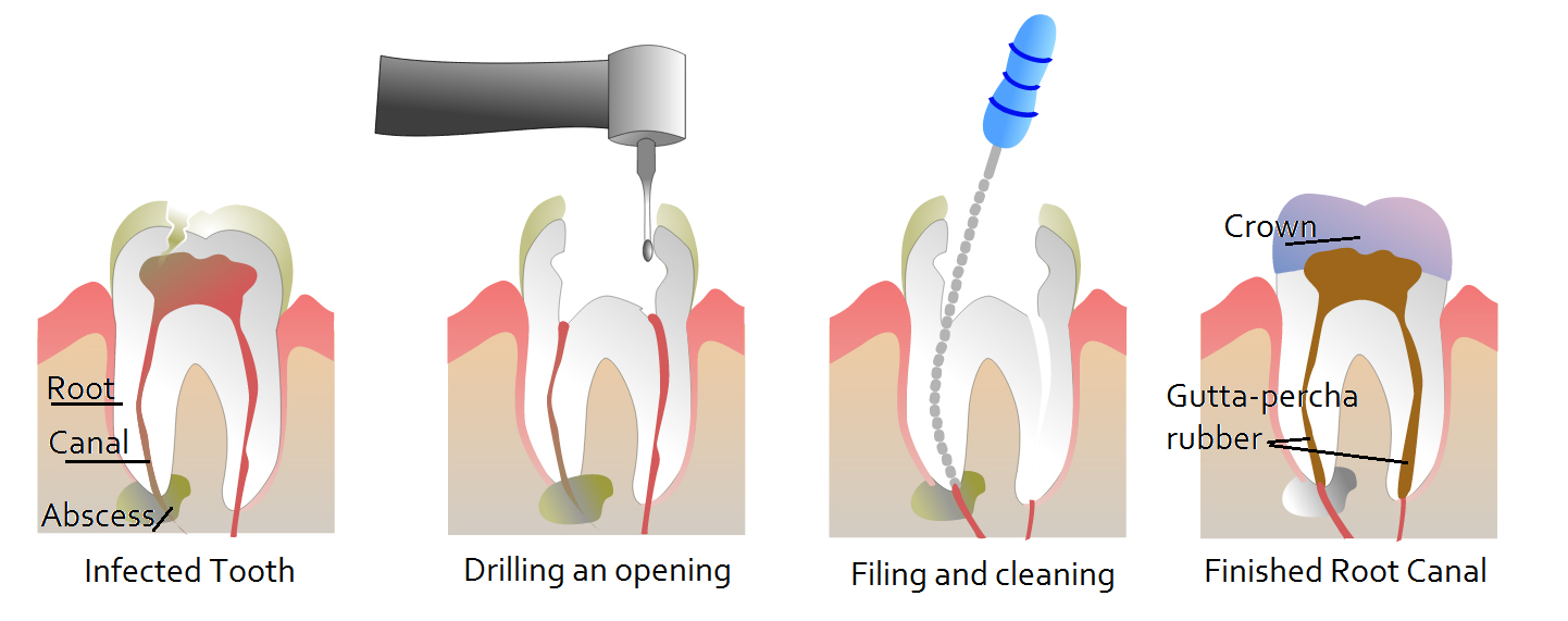 root-canal-treatment